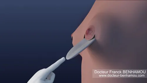 Augmentation mammaire 9