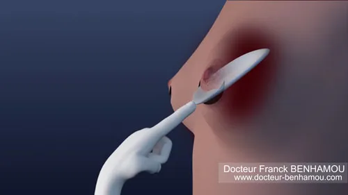 Augmentation mammaire 10