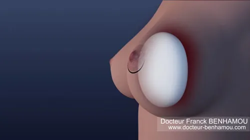 Augmentation mammaire 13