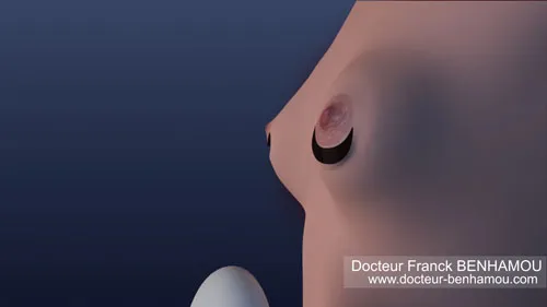 Augmentation mammaire 7