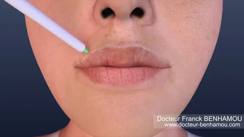 Injection dans les lèvres 6