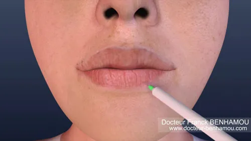 Injection dans les lèvres 8