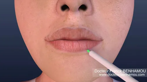 Injection dans les lèvres 9