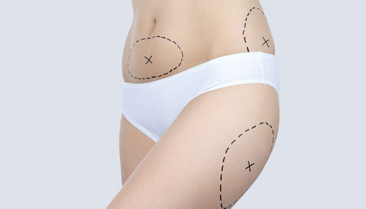 Lipoaspiration sous anesthésie locale