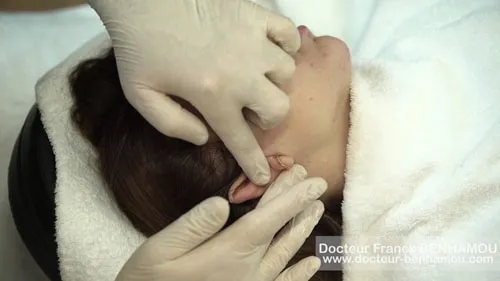 Massage après un lifting