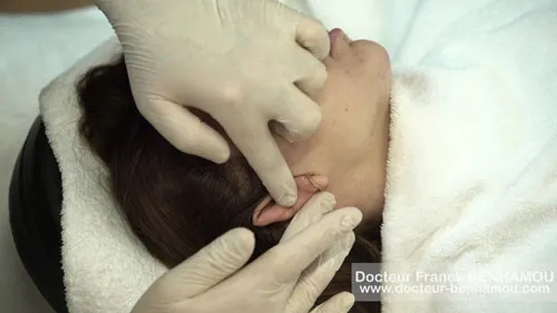 Massage après un lifting