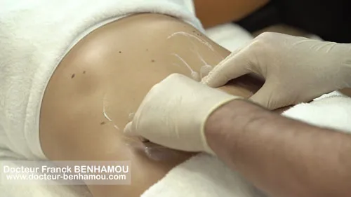 Massage après lipoaspiration 10