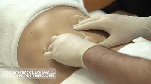 Massage apres lipoaspiration 11