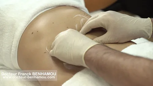 Massage apres lipoaspiration 12