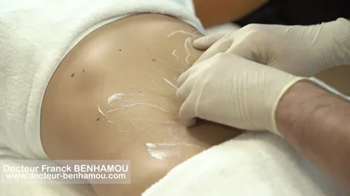 Massage apres lipoaspiration 13