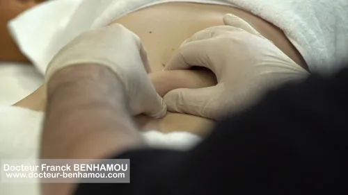 Massage apres lipoaspiration 17