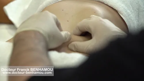 Massage apres lipoaspiration 18