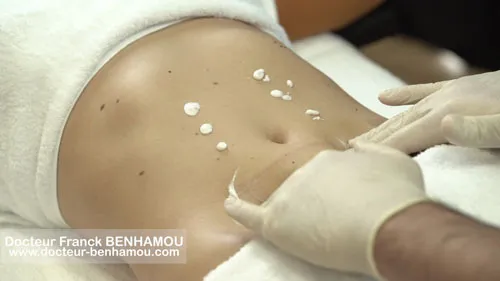 Massage après une lipoaspiration 2