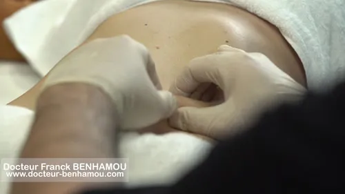 Massage après lipoaspiration 21