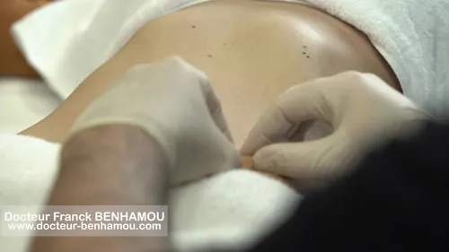 Massage après lipoaspiration 22