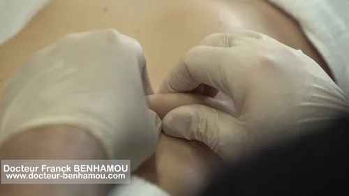 Massage après lipoaspiration 24