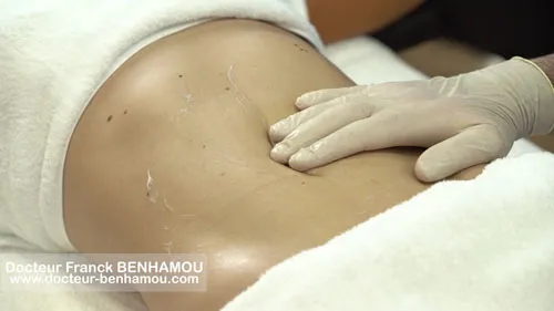 Massage après lipoaspiration 29