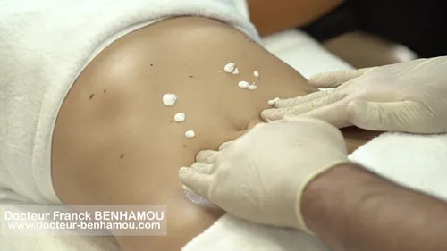 Massage apres lipoaspiration 3