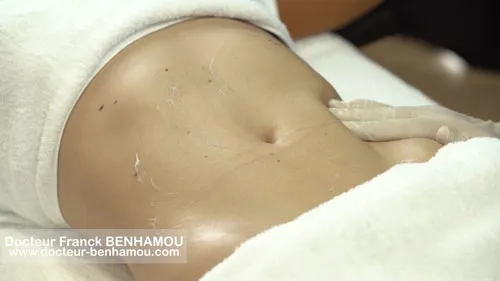Massage après lipoaspiration 31