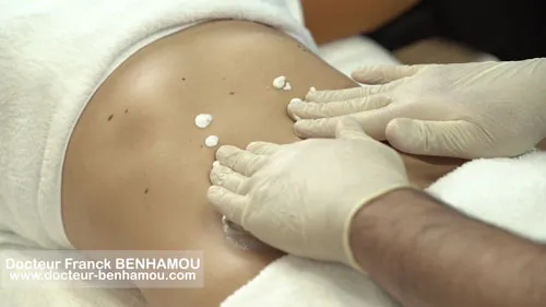 Massage apres lipoaspiration 4