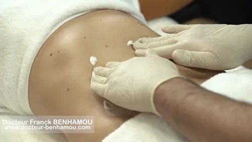 Massage apres lipoaspiration 6