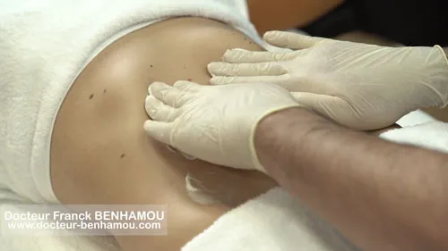 Massage apres lipoaspiration 7