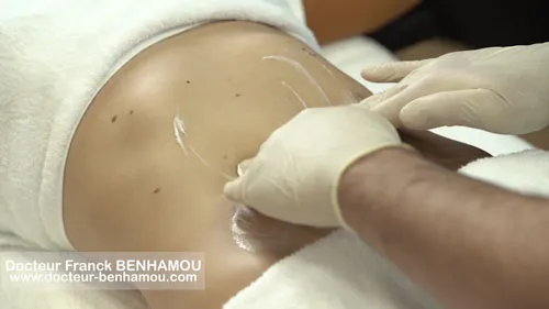 Massage apres lipoaspiration 8