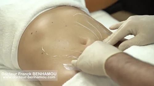 Massage apres lipoaspiration 9