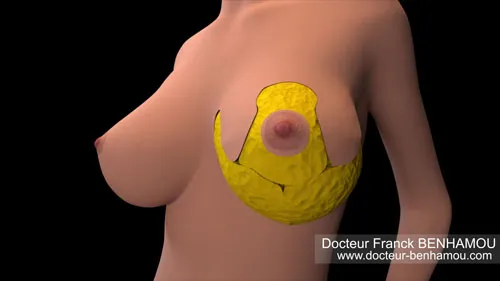 Réduction mammaire 8
