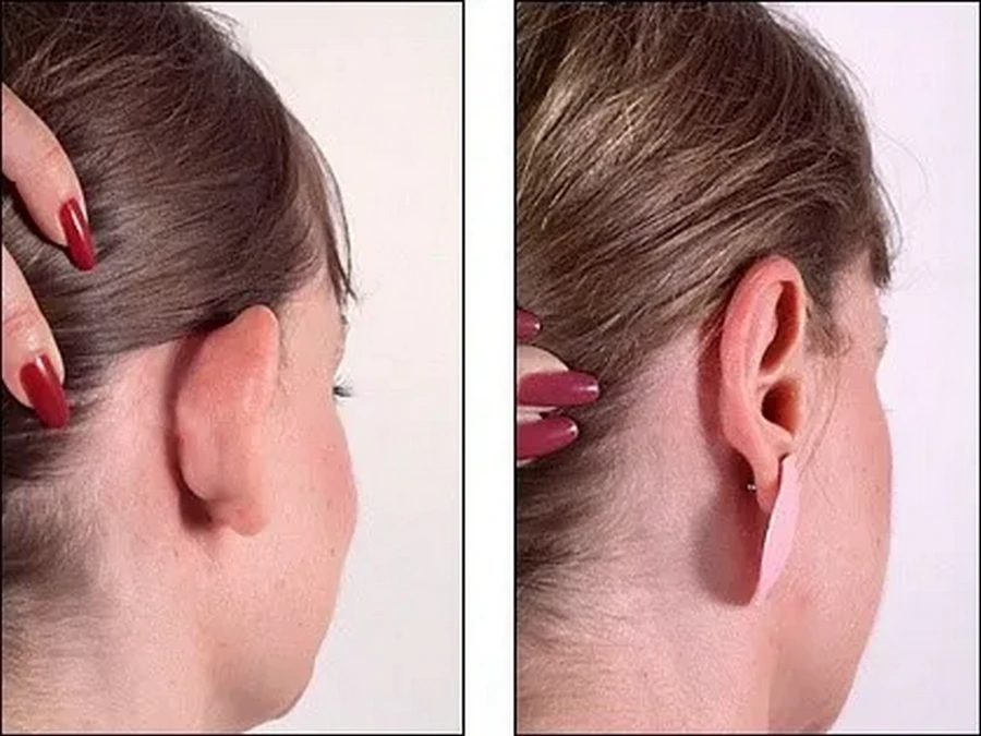 L’otoplastie est-elle remboursée?