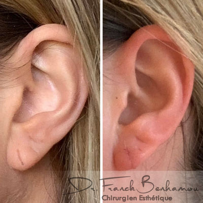 Lobe d'oreille fendu