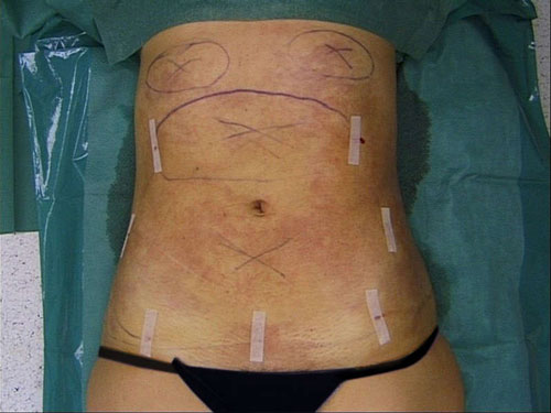Pansements après liposuccion chirurgie esthétique femme