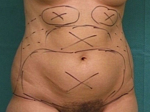 Dessins liposuccion chirurgie esthétique femme