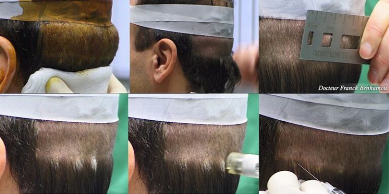 Greffe des cheveux, technique de microgreffes