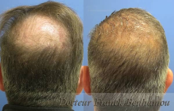 greffe de cheveux cigarette électronique Greffe de cheveux FUE sans cicatrices en France main image 0