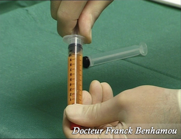 Technique d' injection de graisse dans les fesses