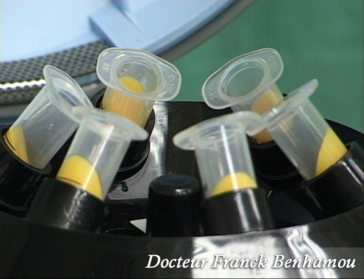 Technique d' injection de graisse dans les fesses