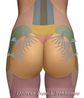 Lipofilling des fesses zone d'injection