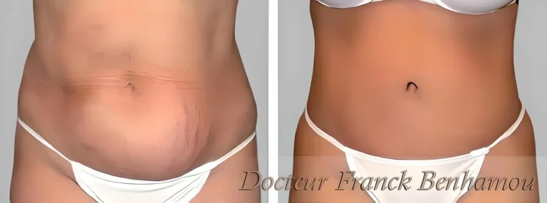 Photo avant/après abdominoplastie