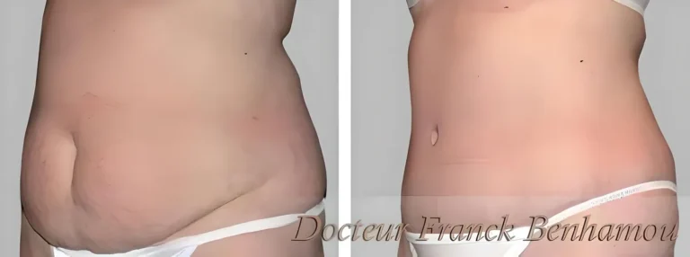 Photos avant après abdominoplastie 6
