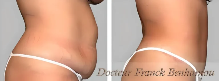 Photos avant après abdominoplastie 4