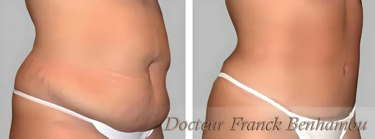 Photos avant après abdominoplastie 3