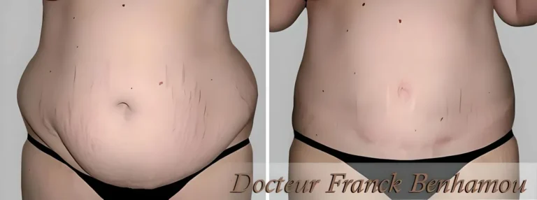 Photos avant après abdominoplastie 8