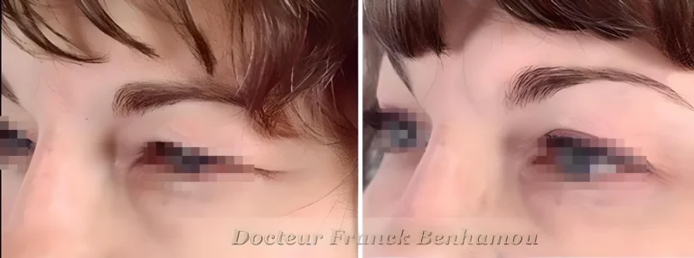 Photo avant/après blépharoplastie 1