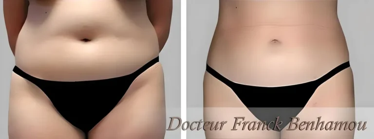 Photos avant après lipoaspiration 1
