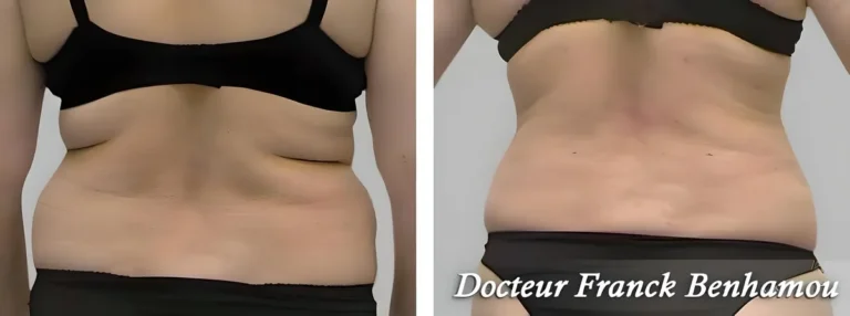 Photos avant après lipoaspiration 4