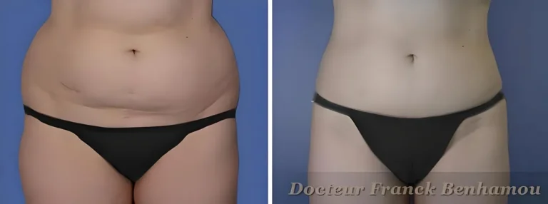 Photos avant après lipoaspiration 3