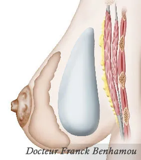 Schéma prothèse mammaire pré musculaire