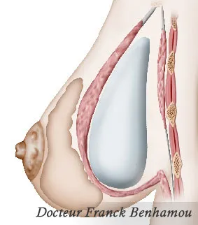 Schéma prothèse mammaire rétro musculaire
