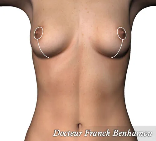 Cicatrice en I pour hypertrophie mammaire